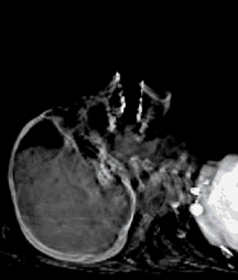 autopsia