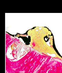 autopsia